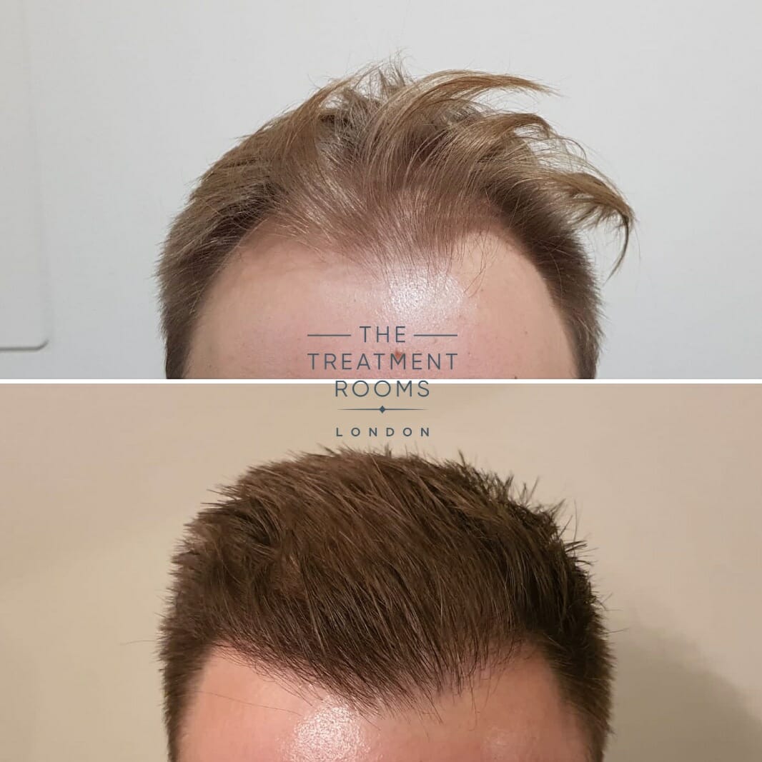FUE hair transplant frontal hairline