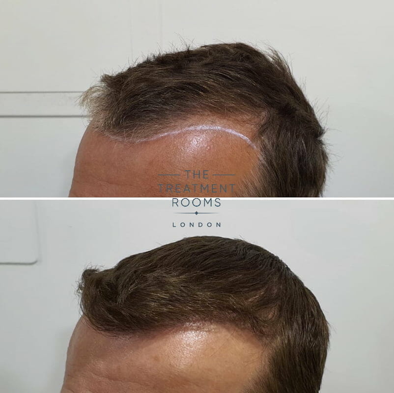 FUE hair transplant hairline 1452 grafts