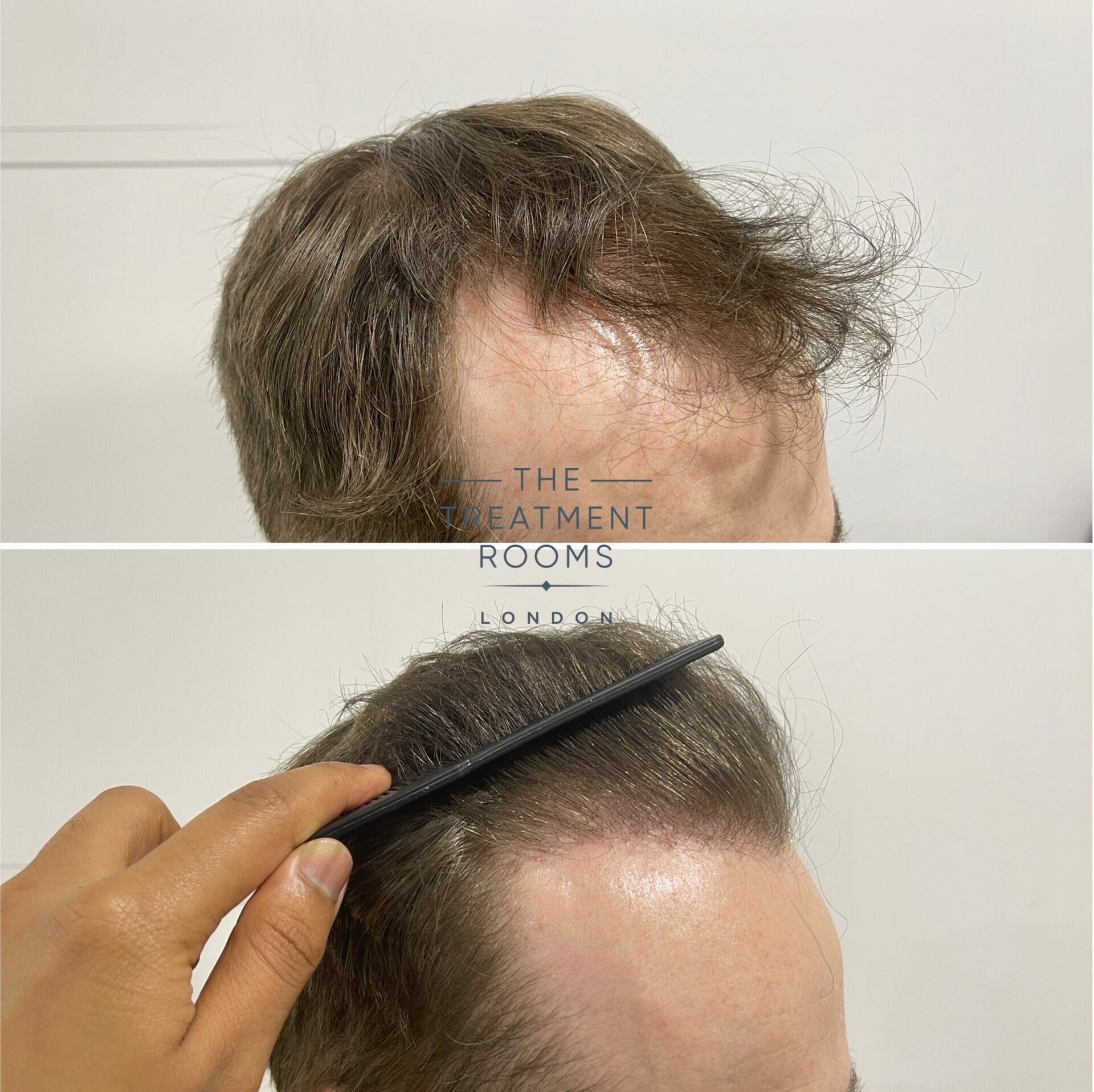 FUE hair transplant london before and after close up