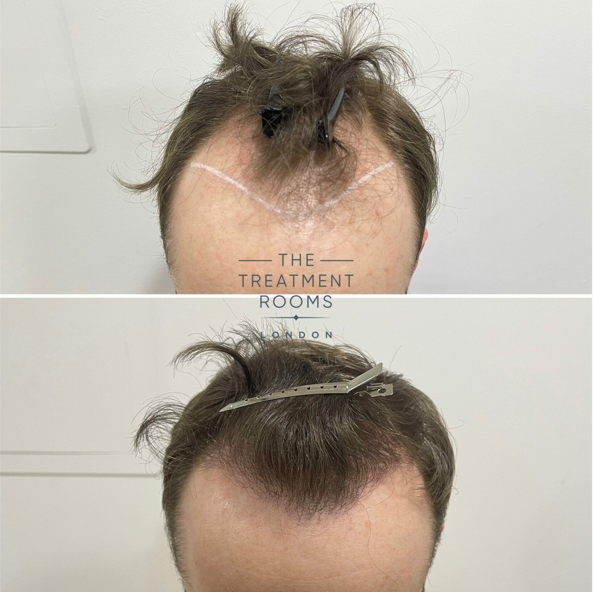 FUE hair transplant london hairline