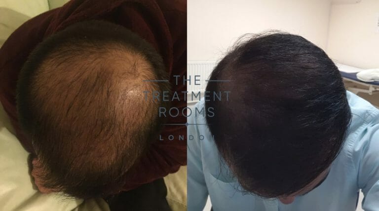 FUE hair transplant crown before and after