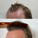 FUE hair transplant result left hairline with comb