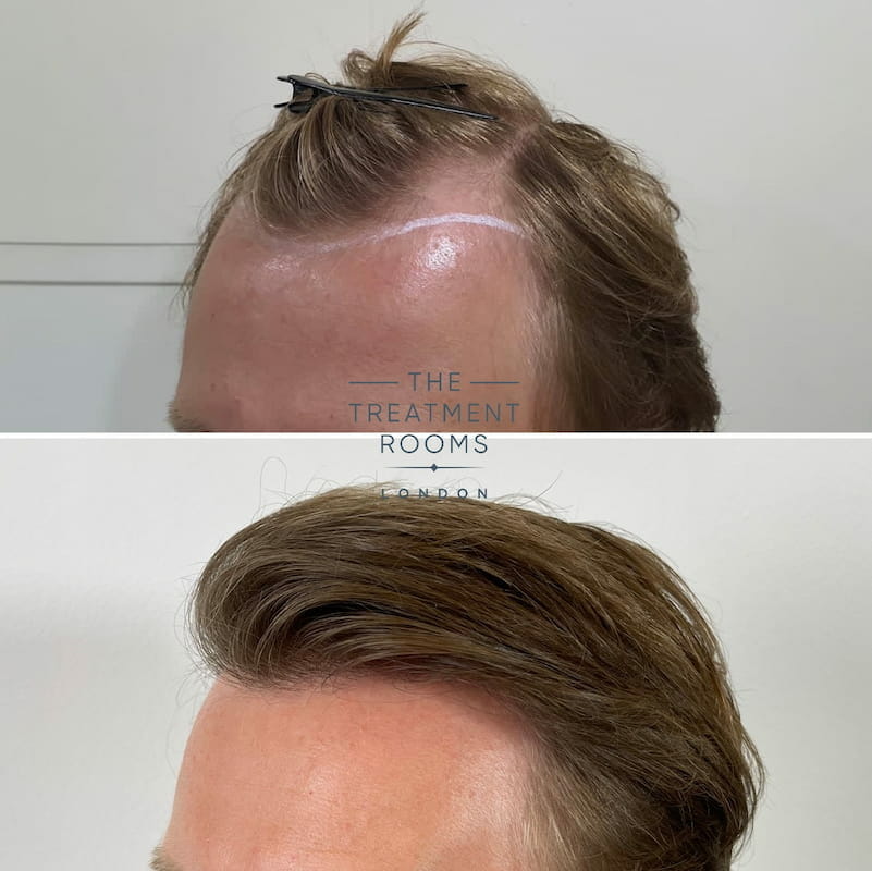 FUE hair transplant result left hairline