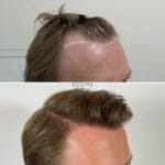 FUE hair transplant result right hairline