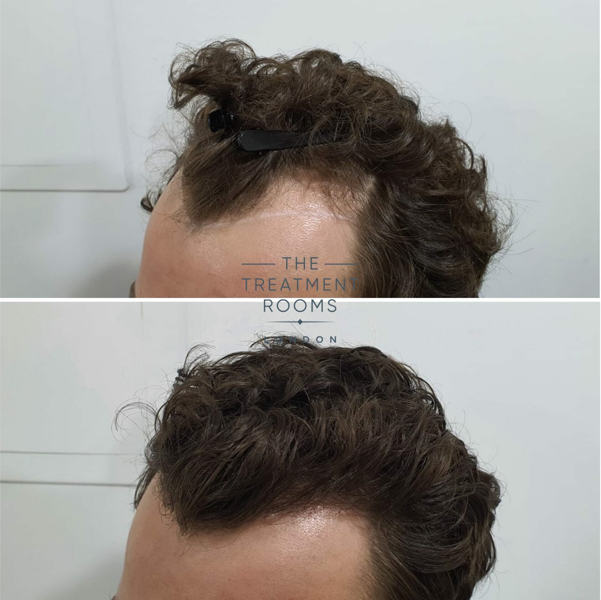 FUE hair transplant review