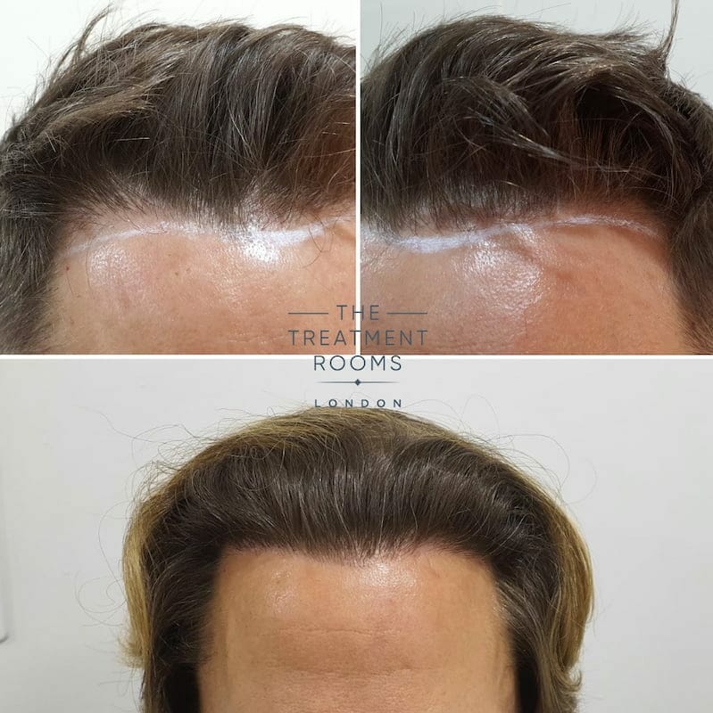 FUE hair transplant surgery fix before and after