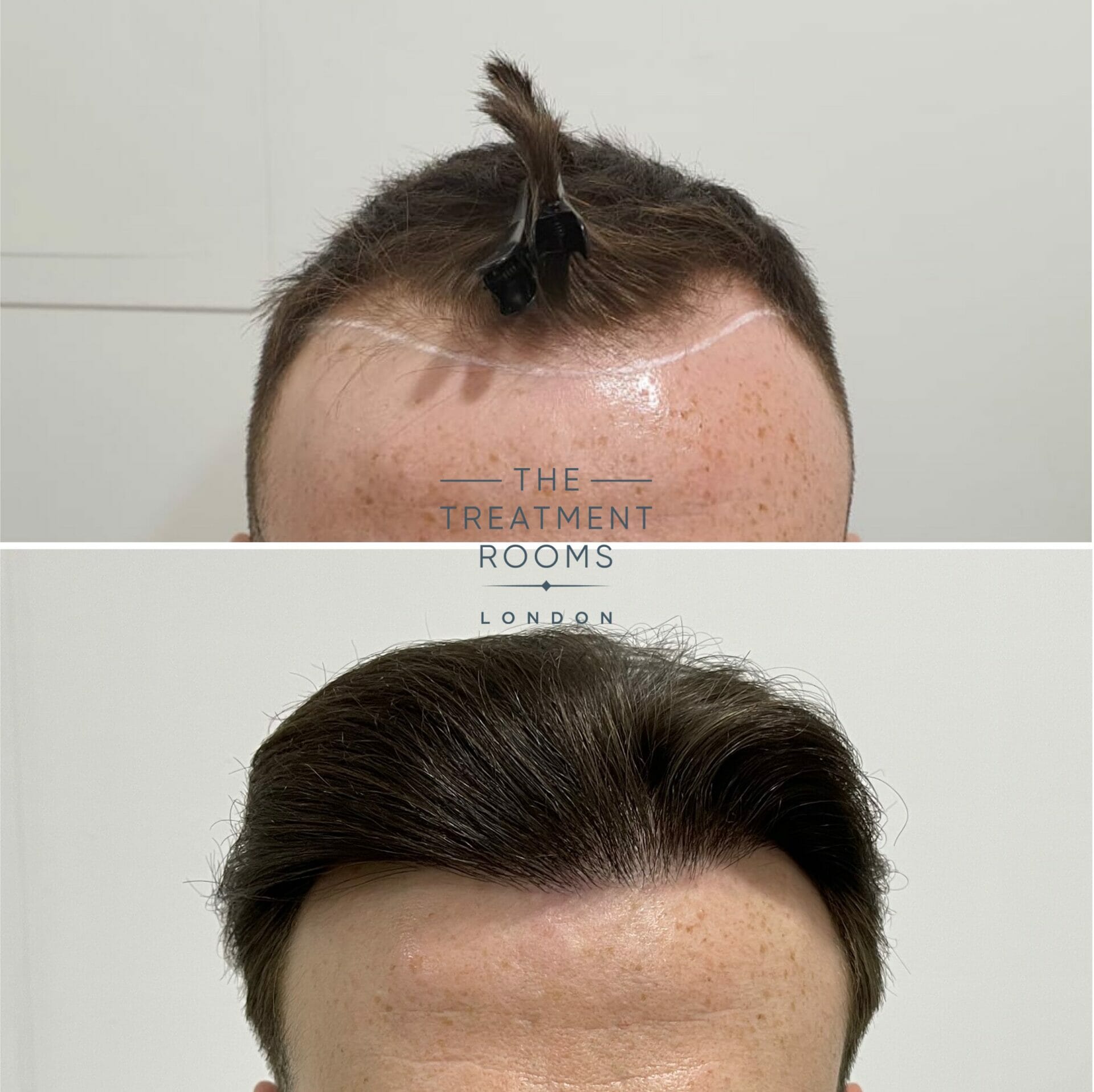 FUE surgery Receding hairline