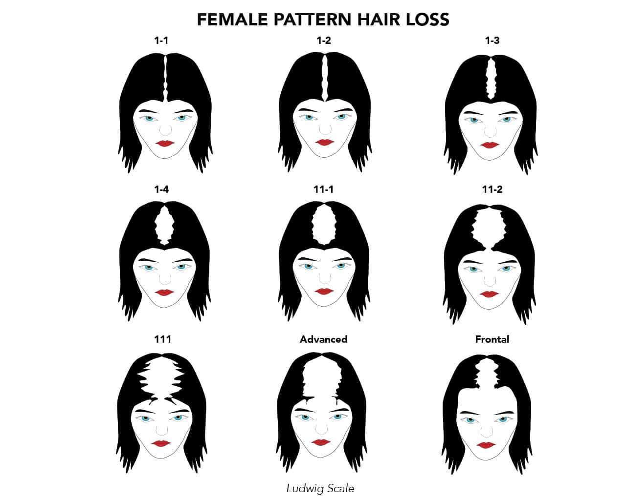 The Hair Loss Guide for Women Plus Regrowth Tips  Treatments  Allure