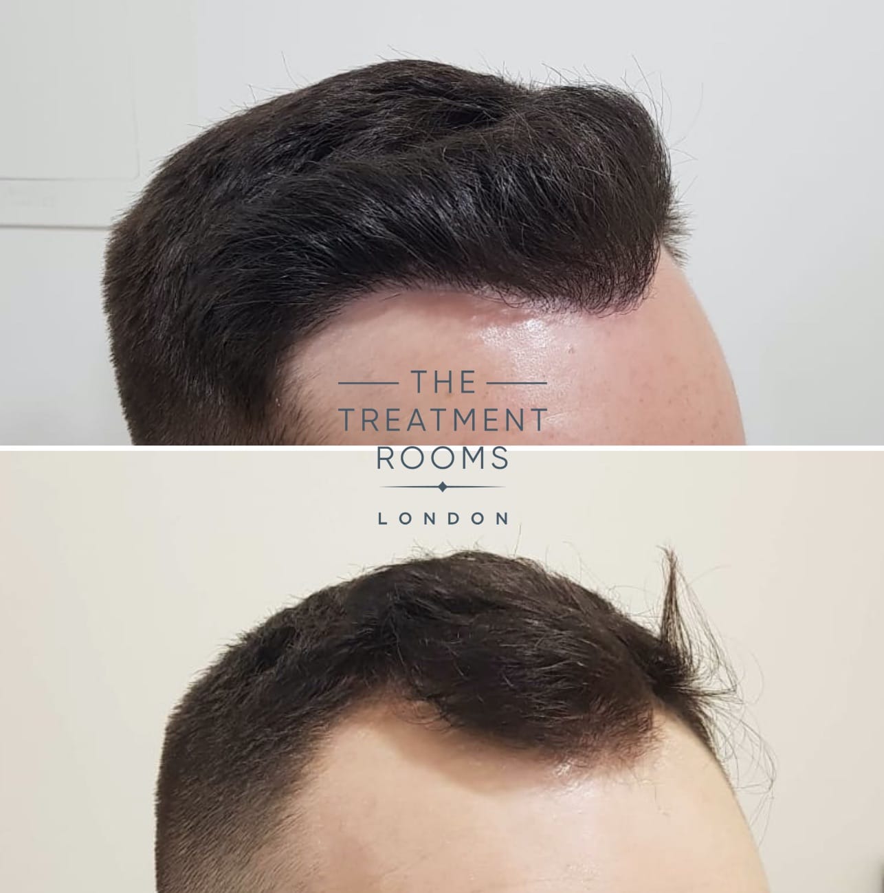 Does Finasteride Regrow Hair? | Treatment Rooms London