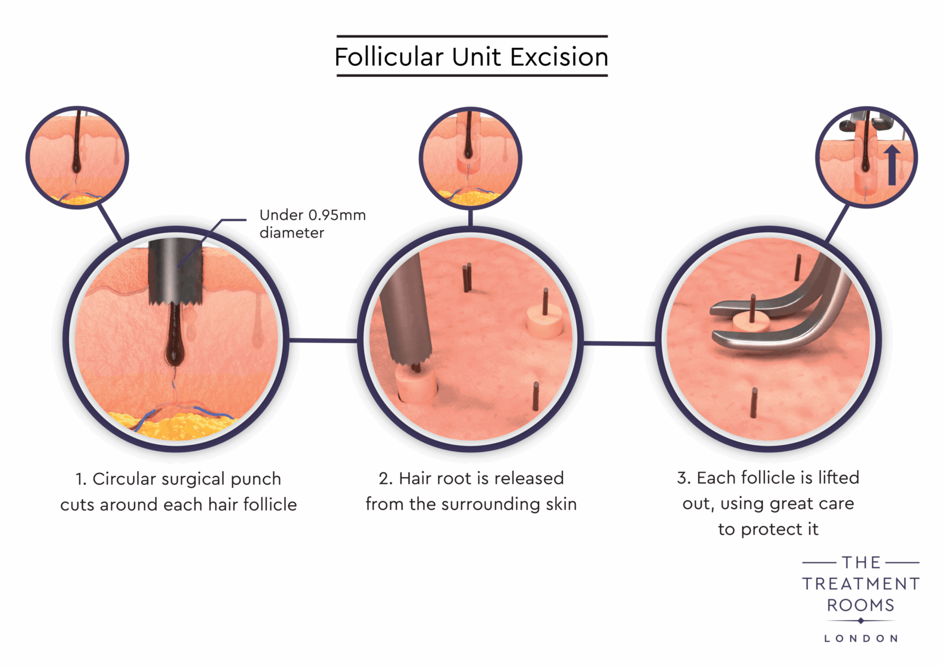 Follicular Unit Excision Diagram