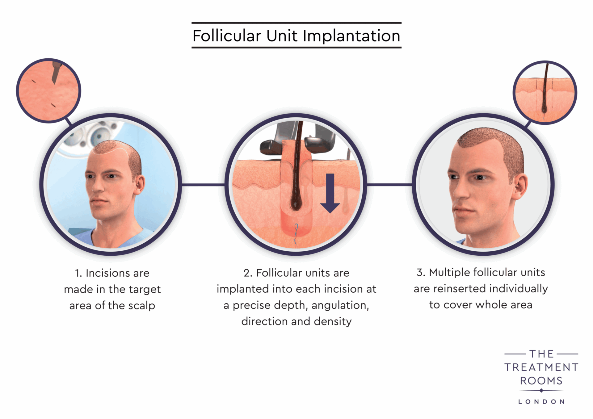 Follicular Unit Implantation Diagram
