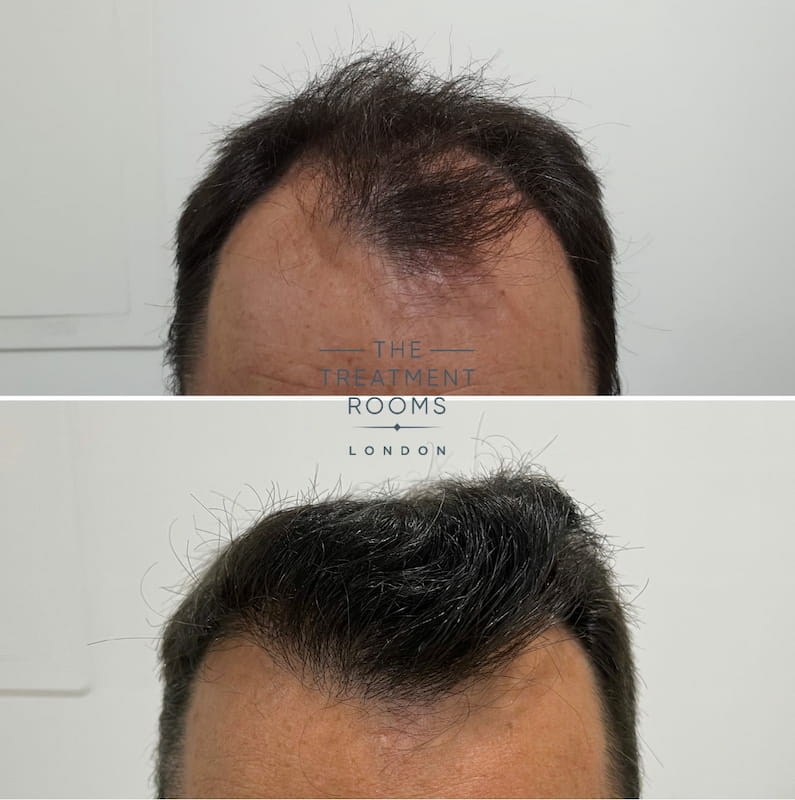 Front FUE hair transplant before and after