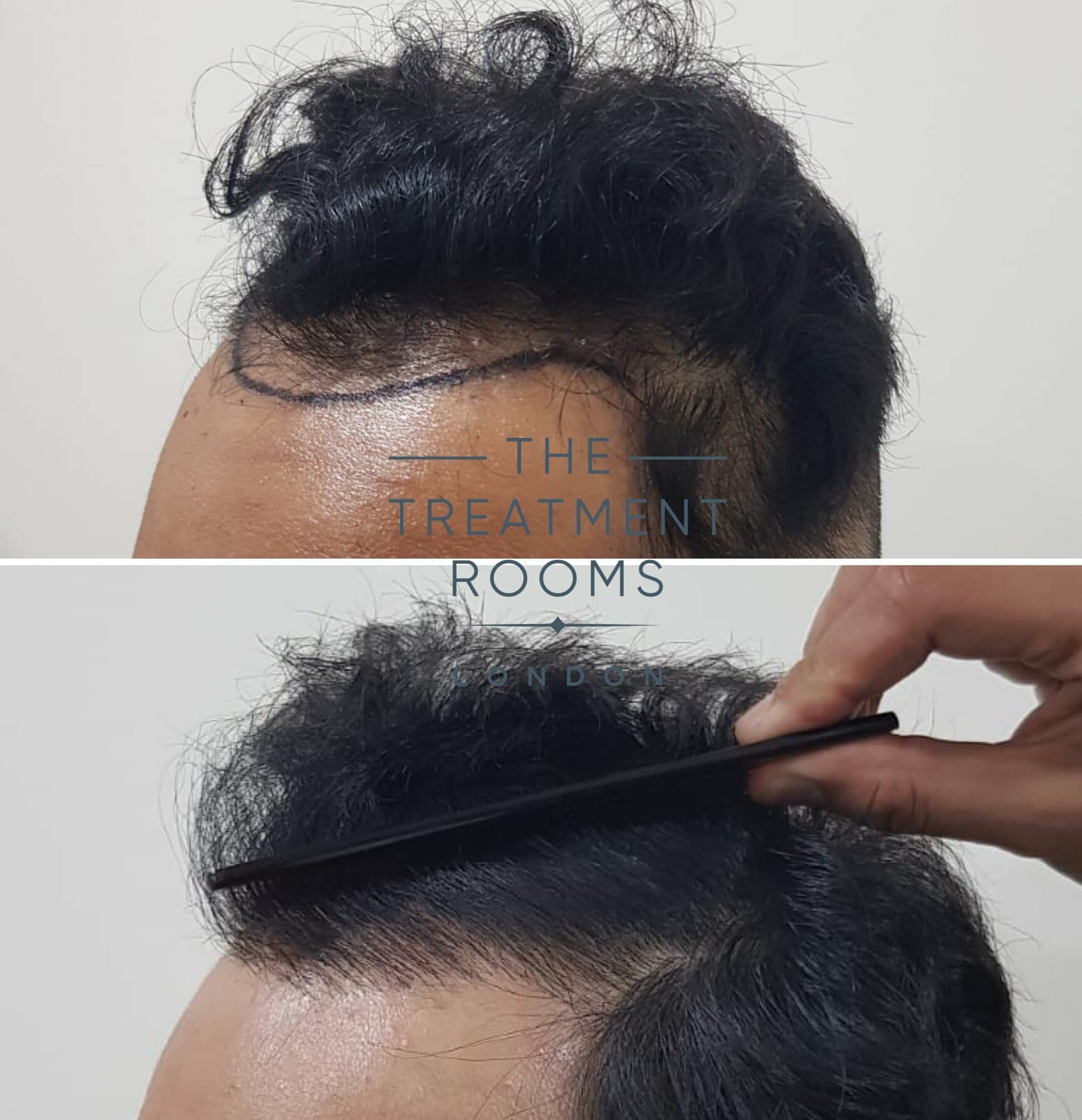 front and left temporal hairline hair transplant