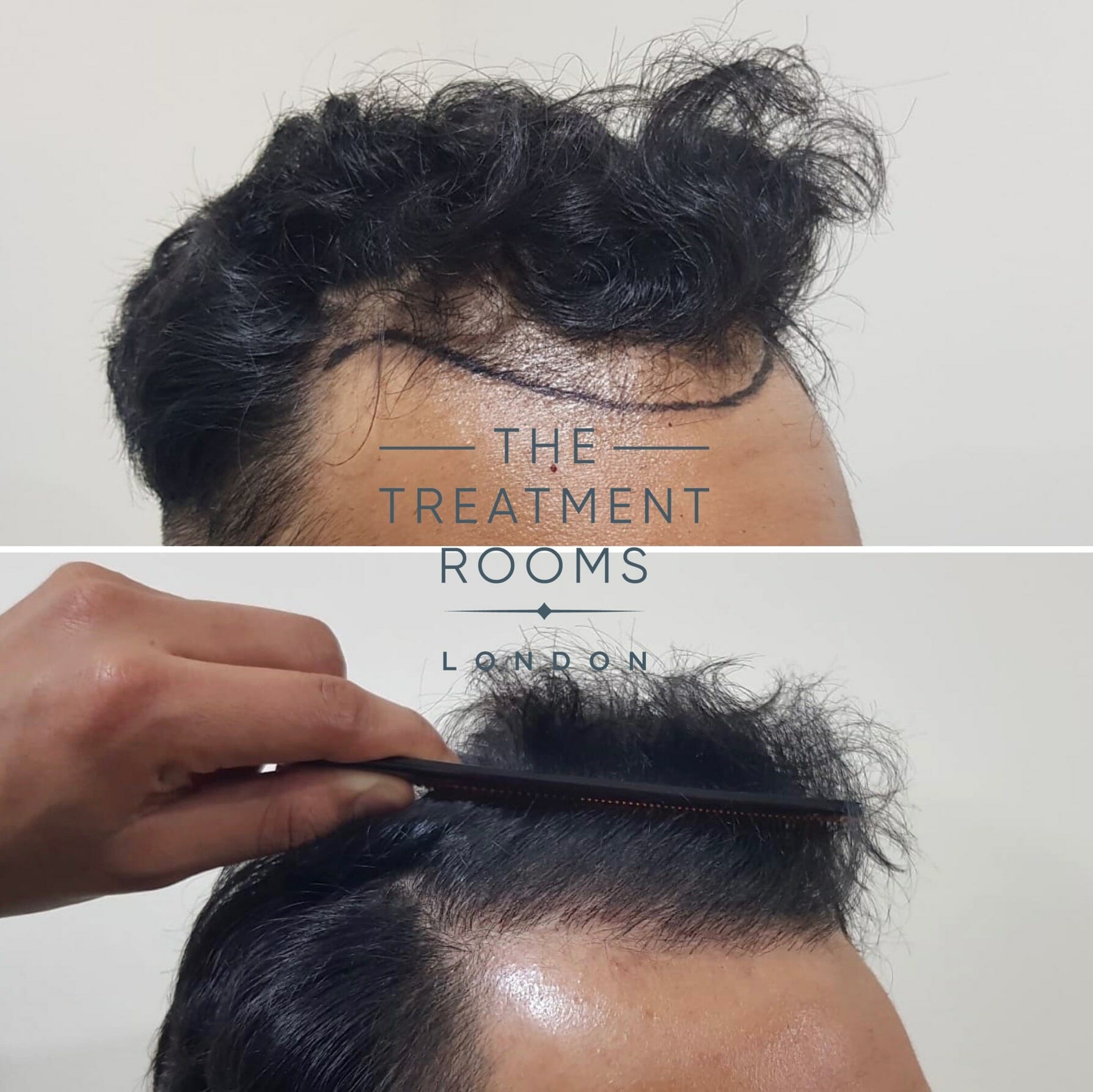front and right temporal hairline hair transplant