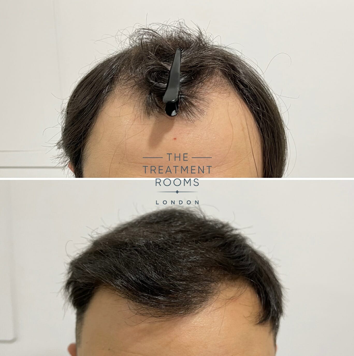 Front hair transplant before and after