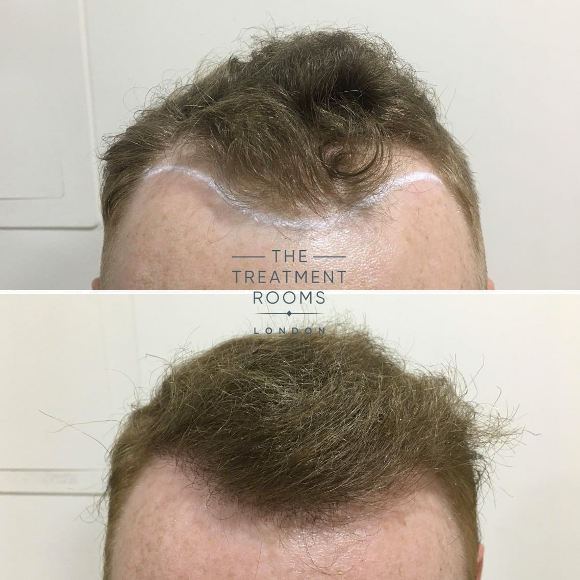 Front with Hairline Hair Transplant