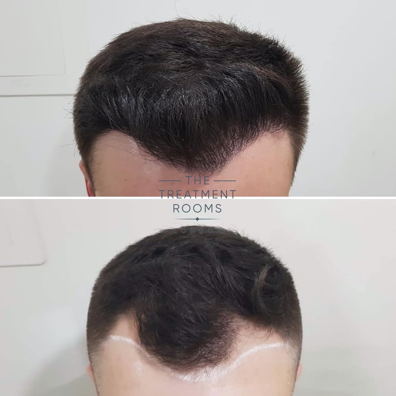 Frontal Hairline FUE hair transplant before and after Frontal Hairline FUE hair transplant before and after