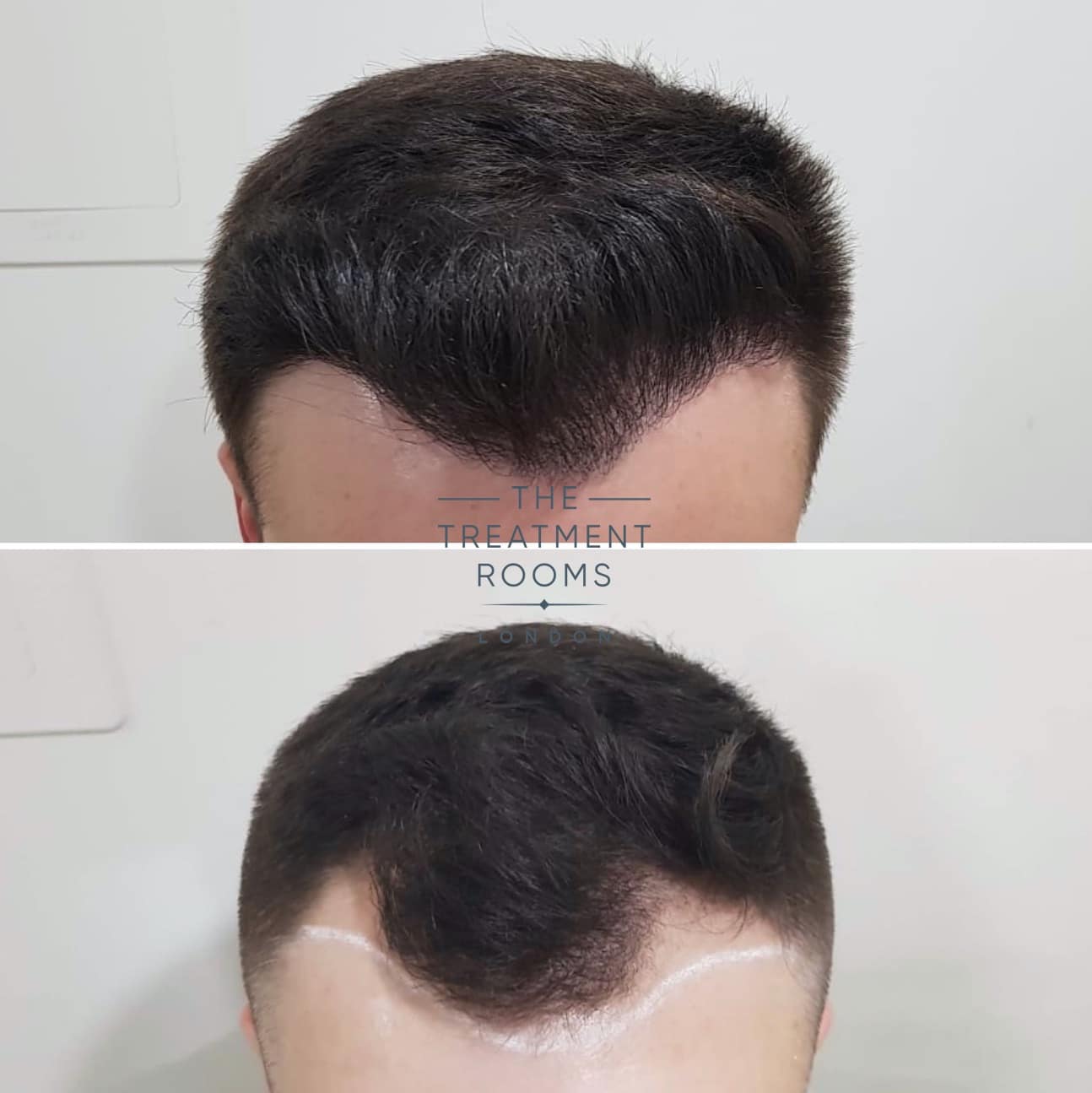 Frontal Hairline FUE hair transplant before and after
