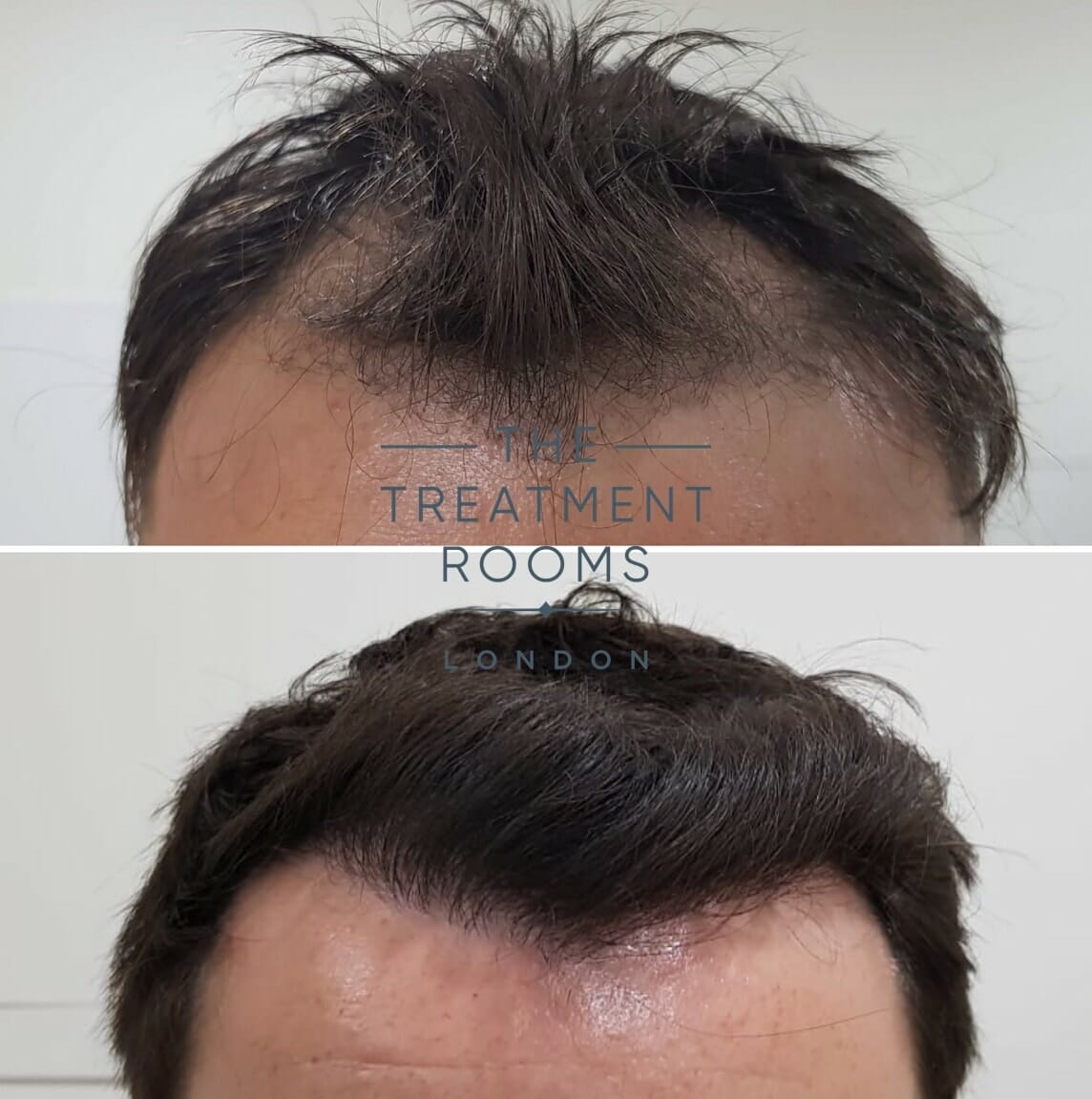 frontal hairline hair transplant london