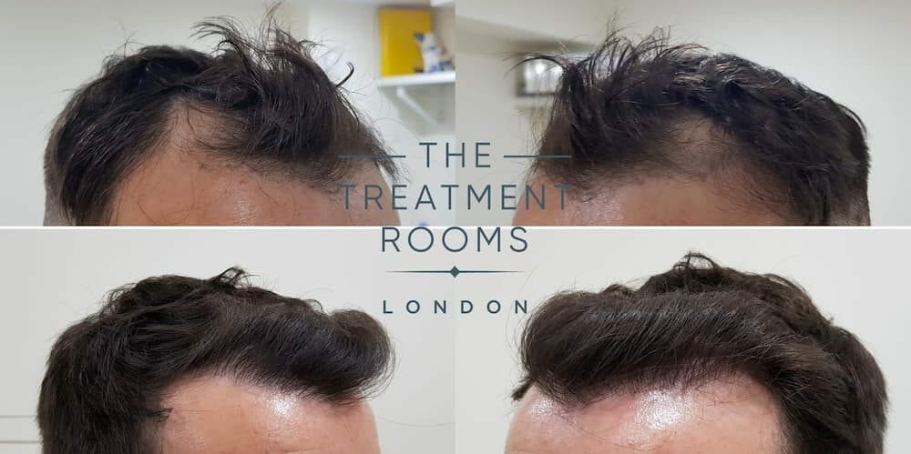 front and hairline hair transplant