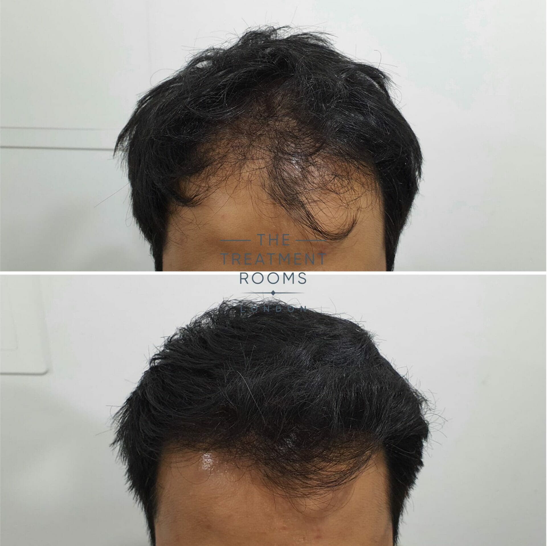 Frontal hairline FUE hair transplant 1818 grafts