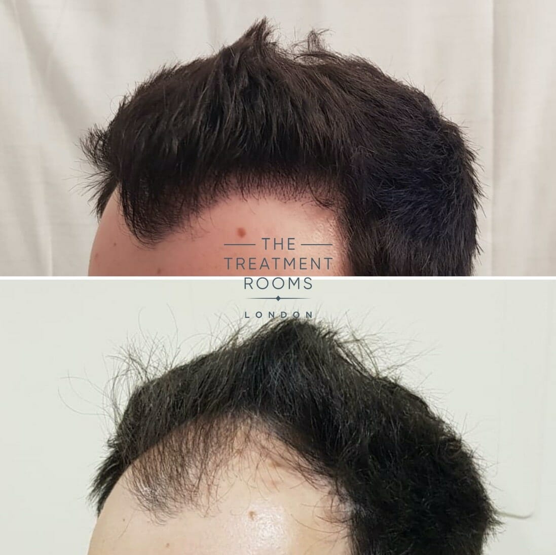 Going back to work after hair transplant