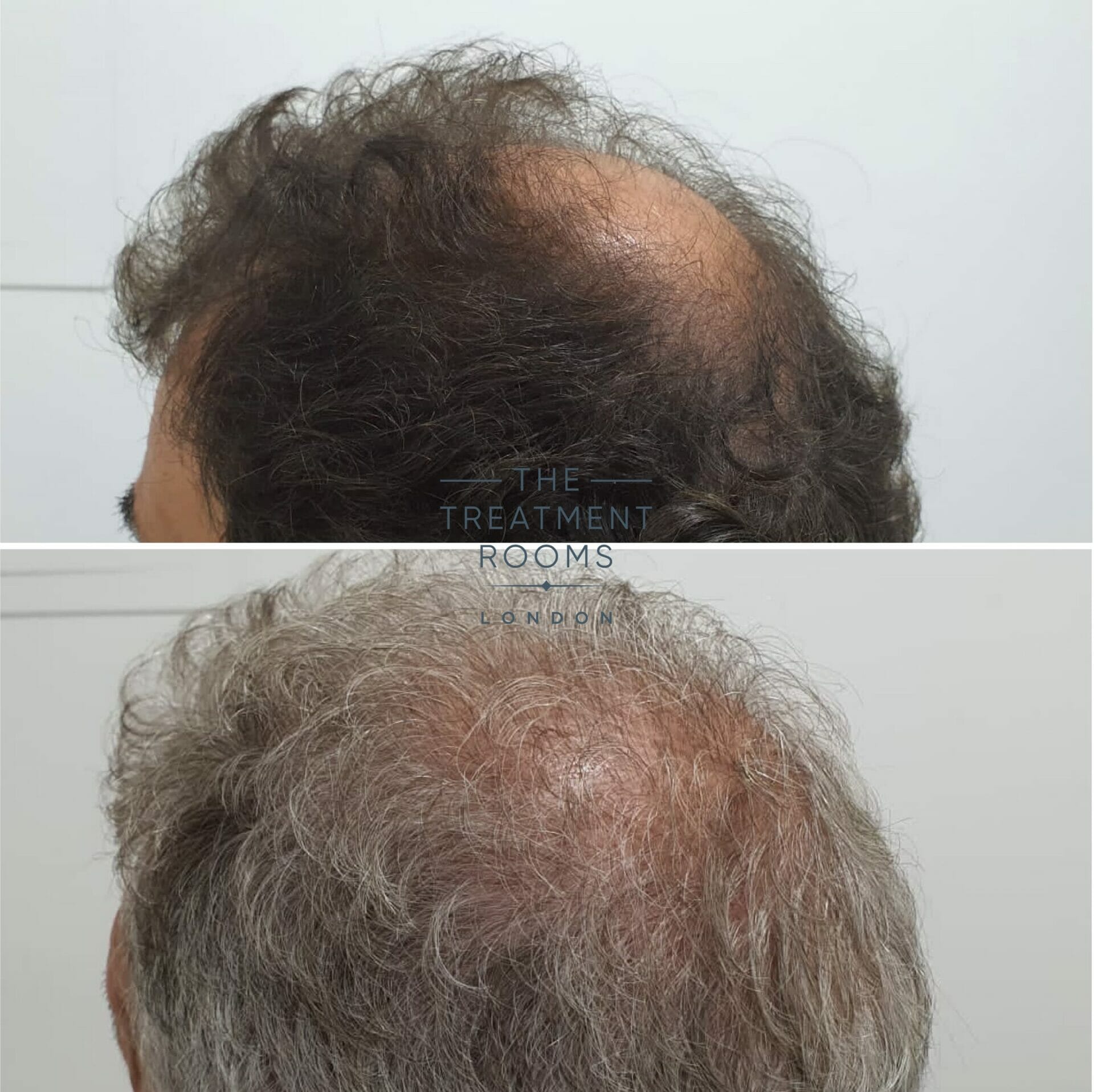 Grey hair crown transplant before and after 2110 grafts