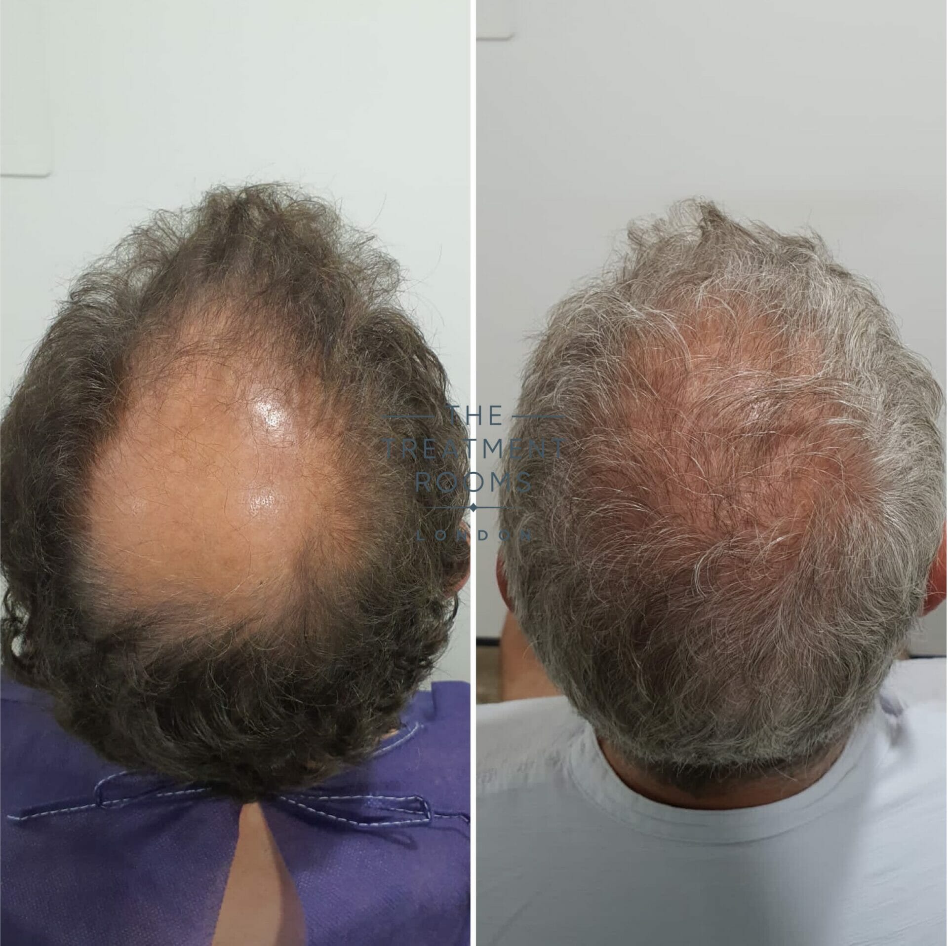 Grey hair crown transplant result 2110 grafts