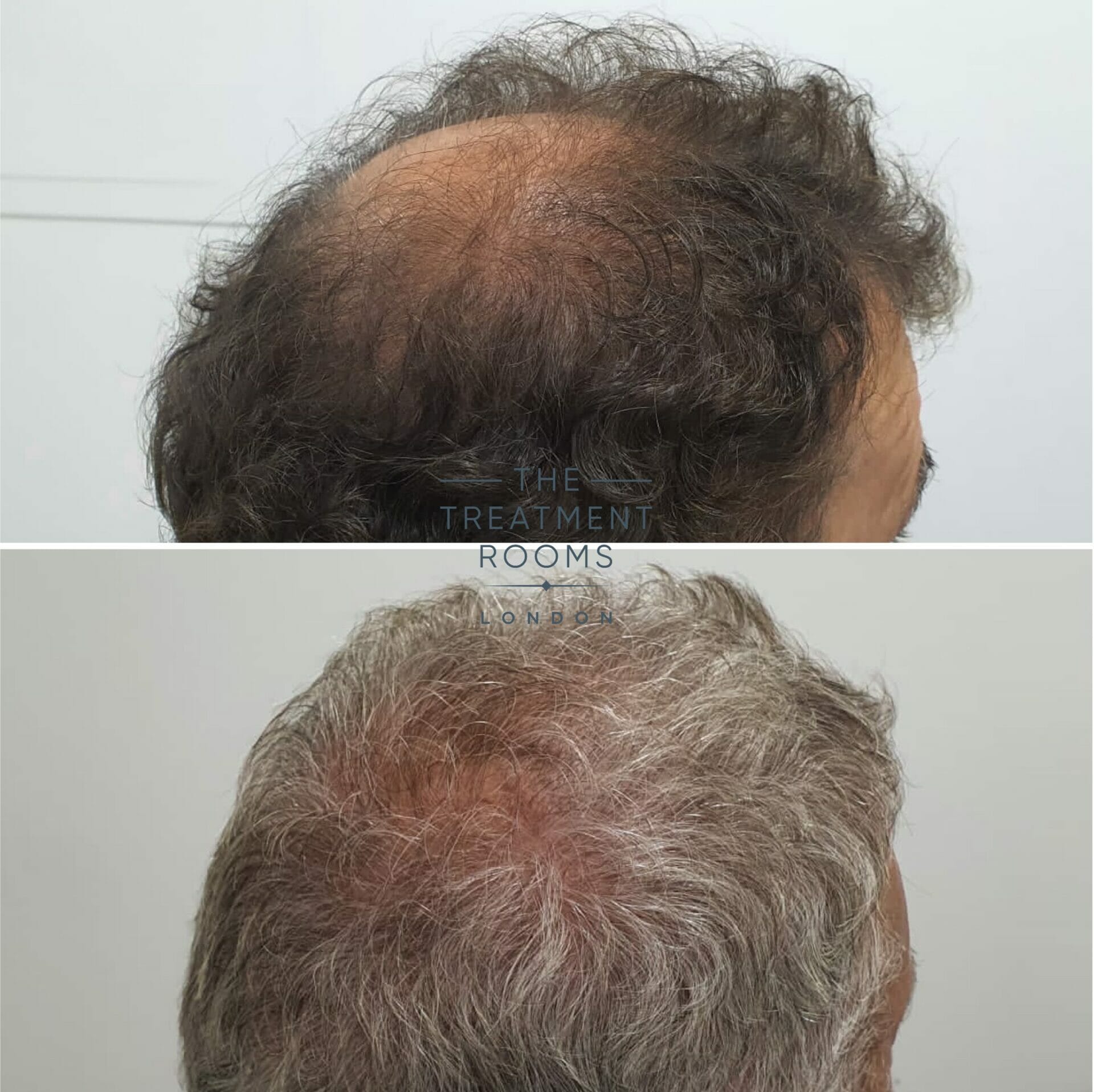 grey hair transplant before and after