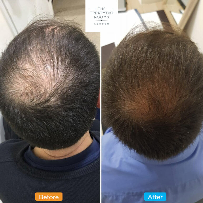 Hair thinning crown male pattern baldness