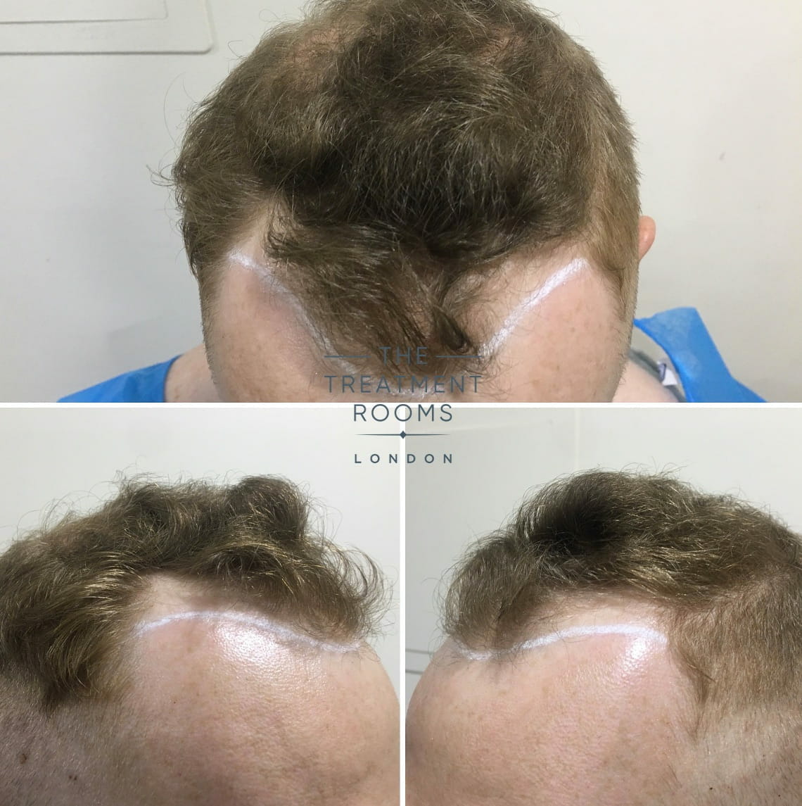 Hair Loss Before FUE hair transplant