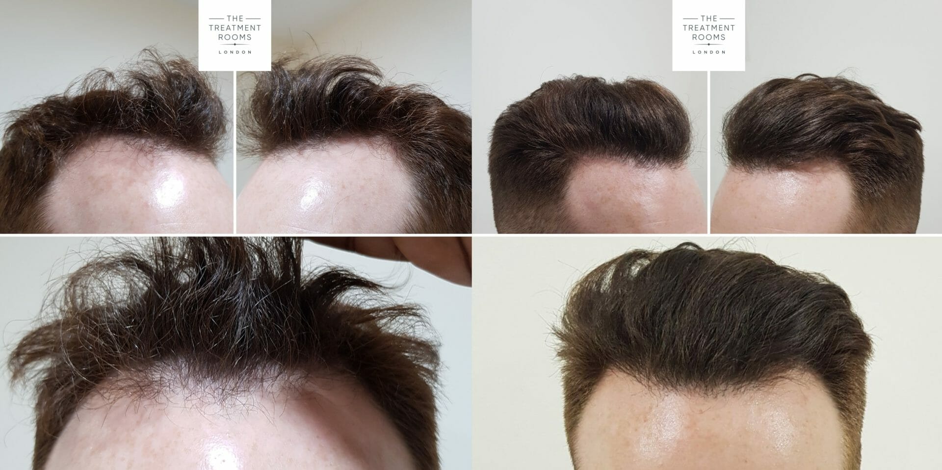 Hair Transplant before and after