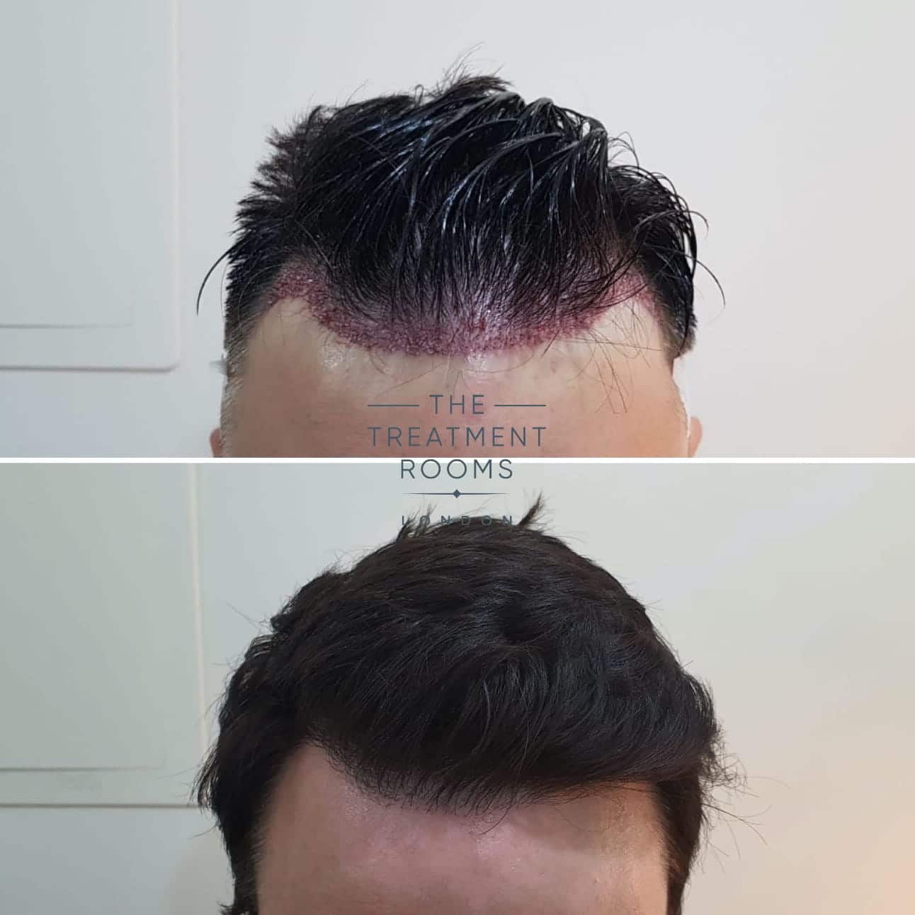Hair Transplant Hairline Before and After Straight hair Hair Transplant Hairline Before and After Straight hair