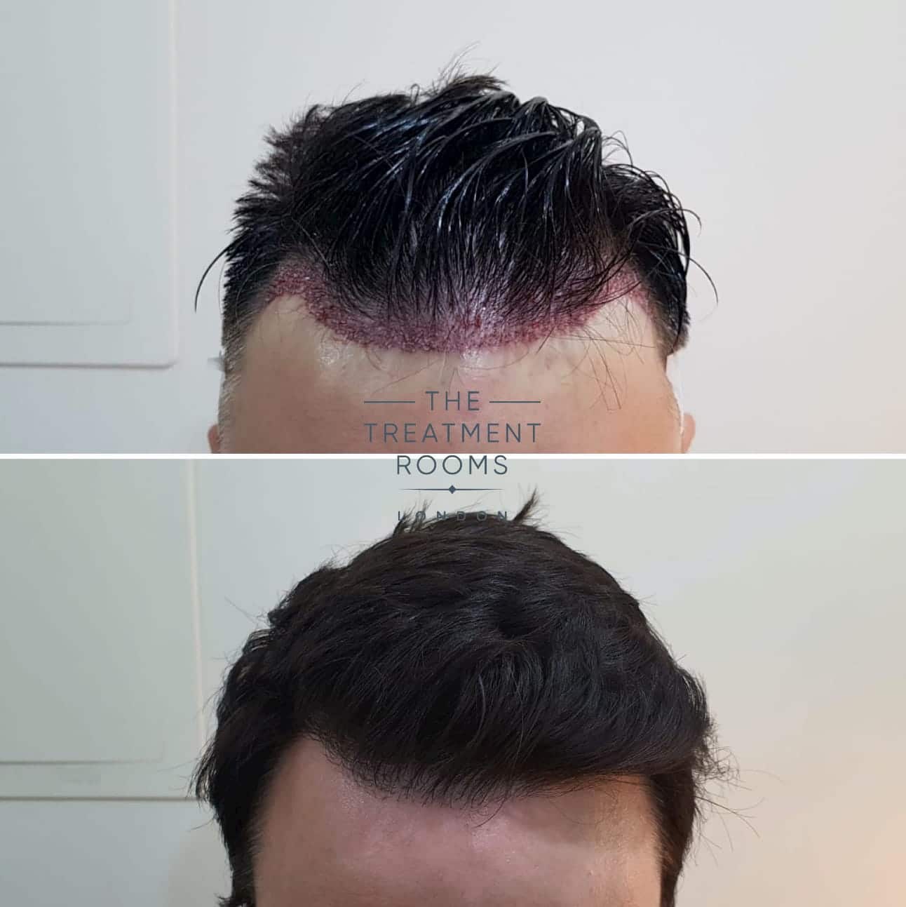 Hair Transplant Hairline Before and After Straight hair