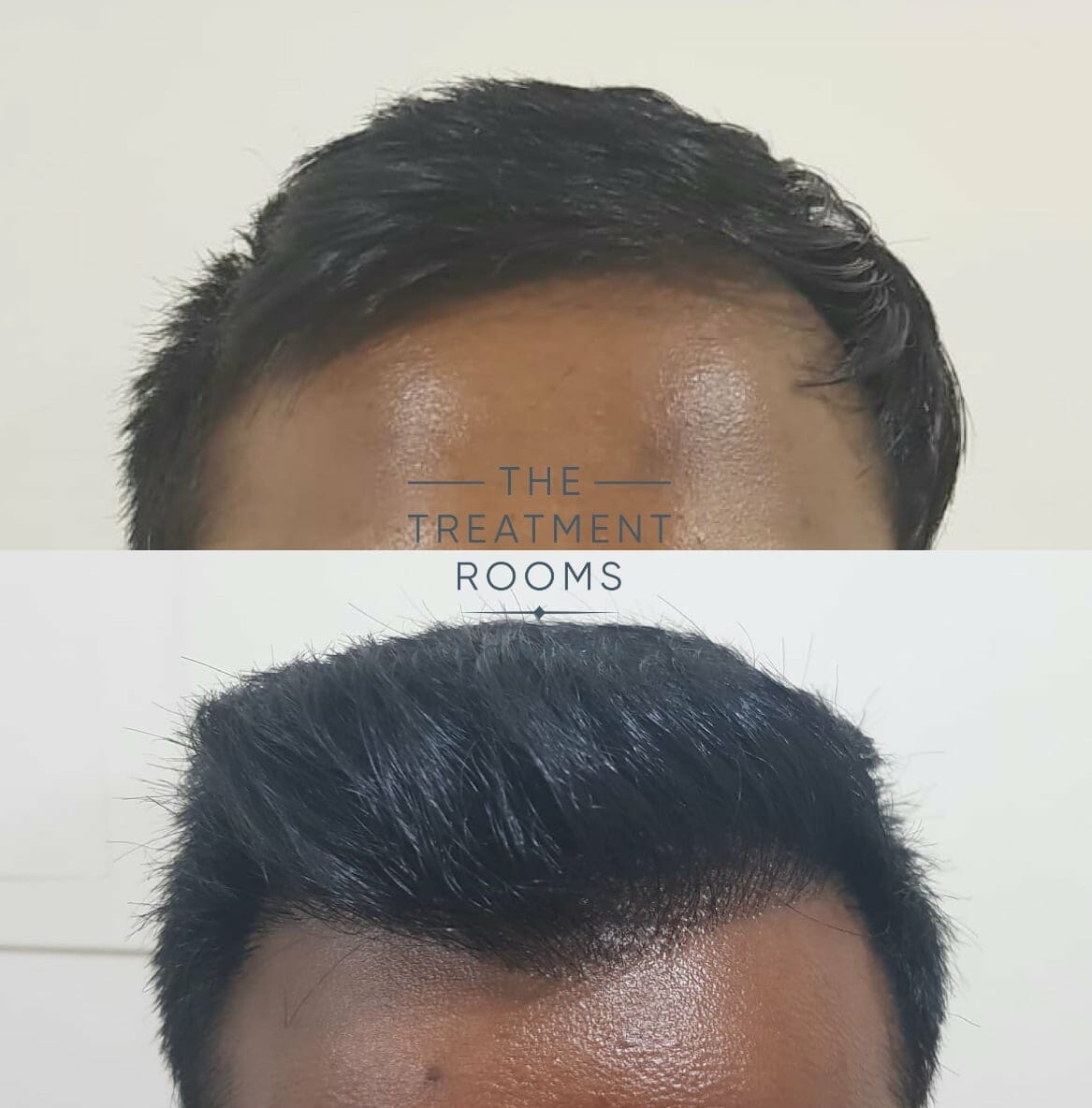 Hair Transplant Hairline Hair Transplant Hairline