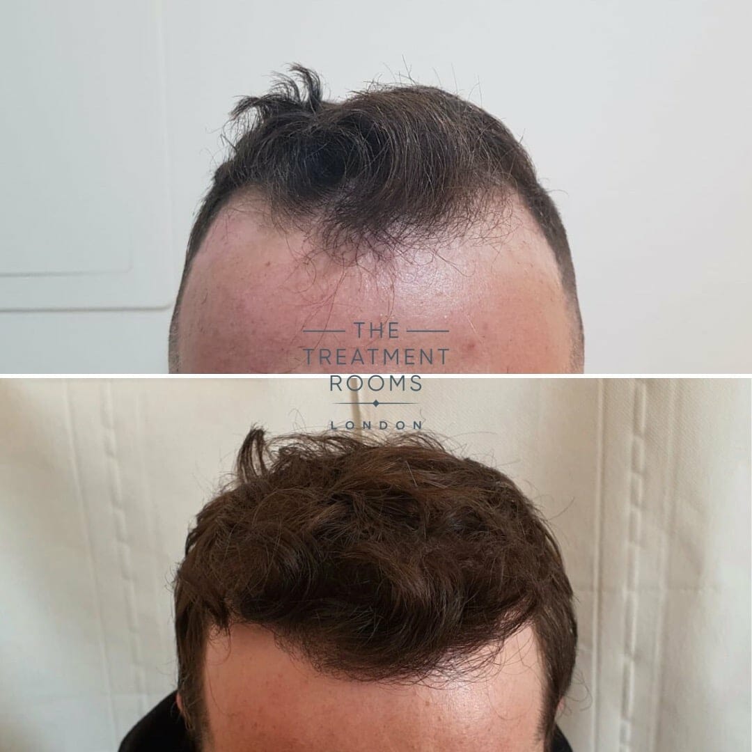 Hair Transplant London Before and After