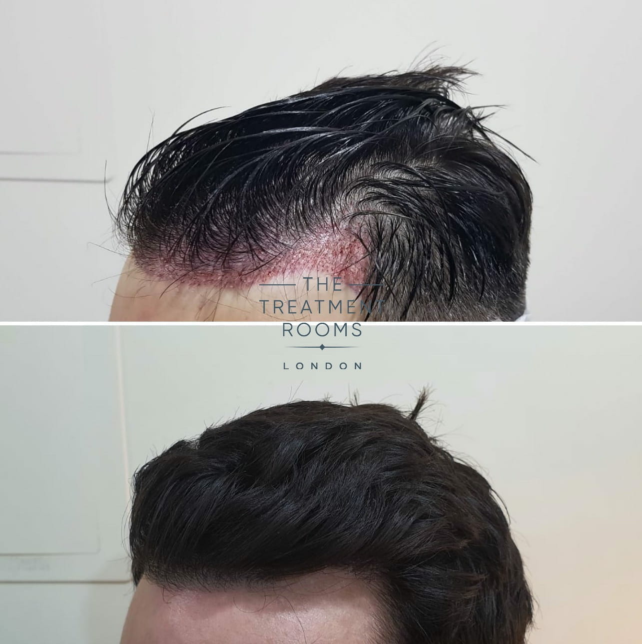 Hair Transplant London Before and After Straight hair