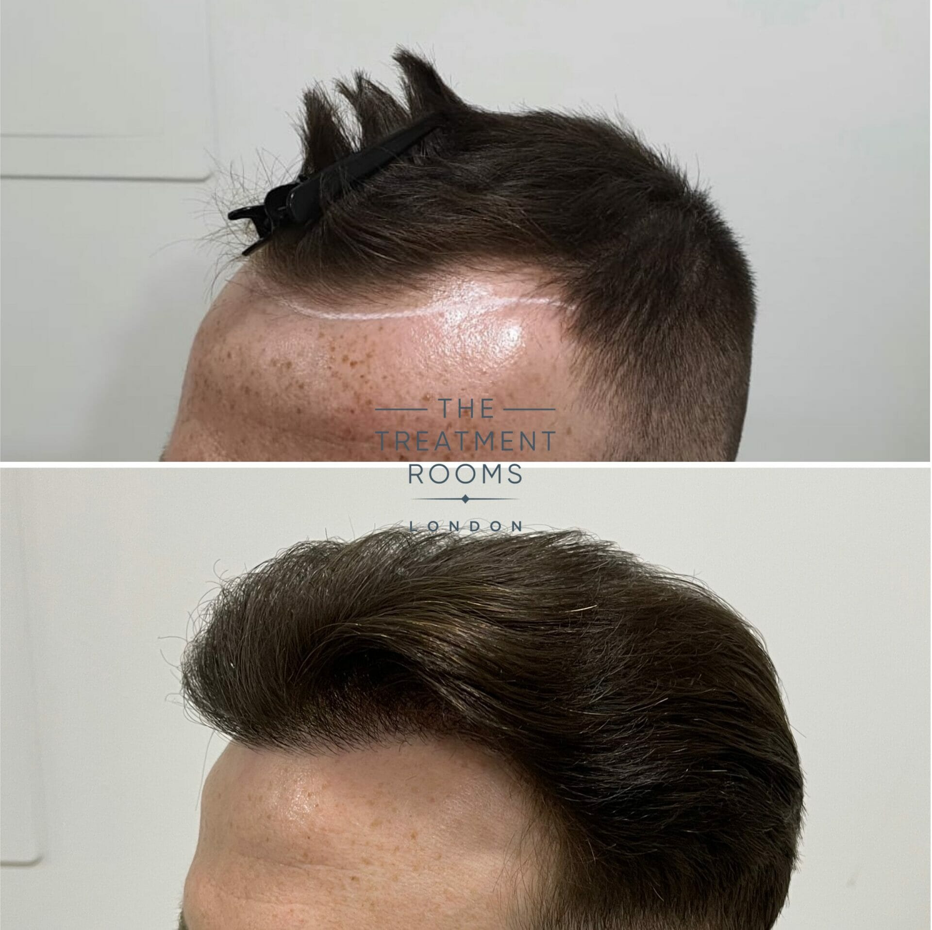 Hair transplant Treatment Rooms London