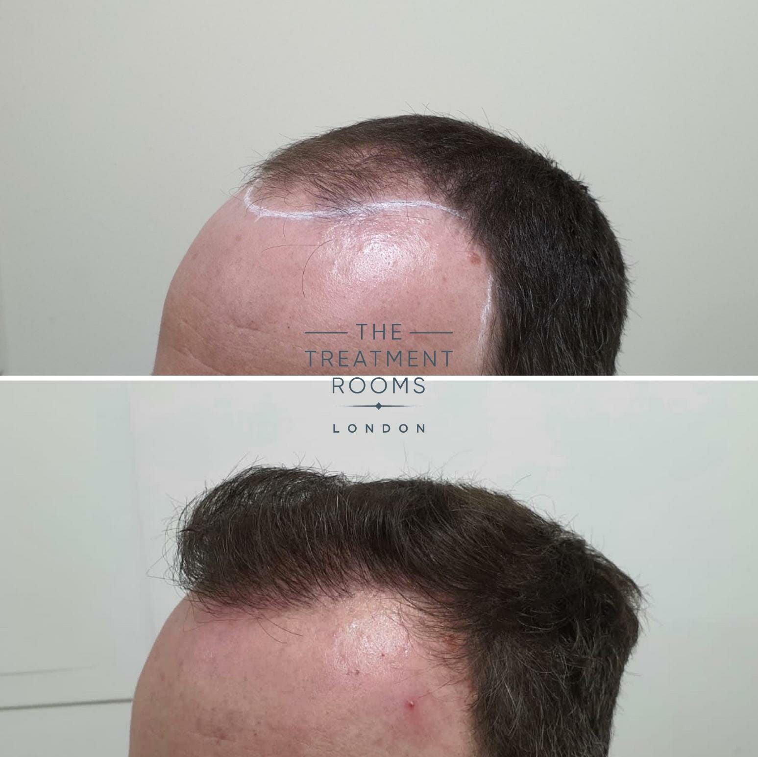 norwood 4 hair transplant before and after