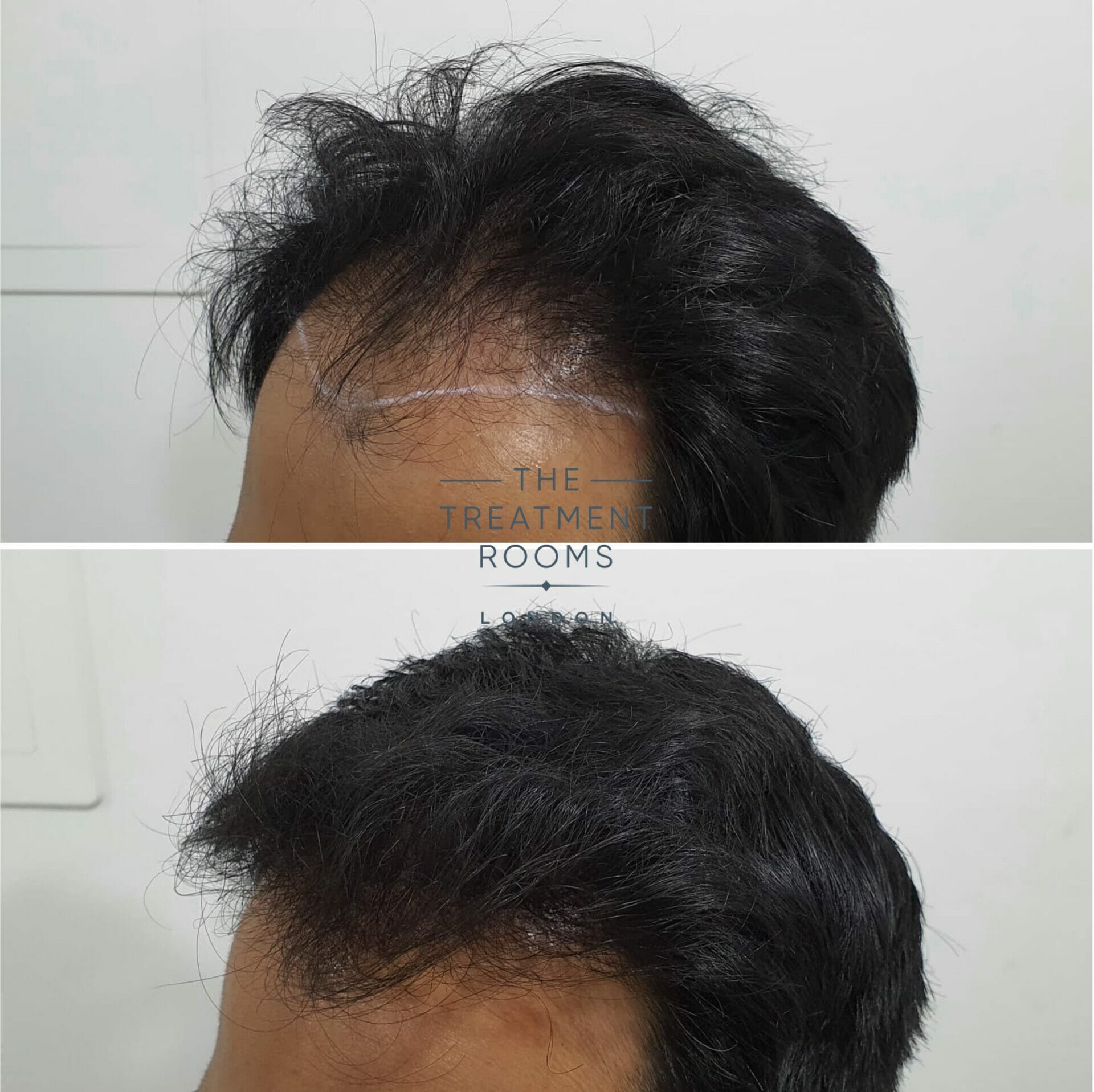 Hair transplant london hairline 1818 grafts