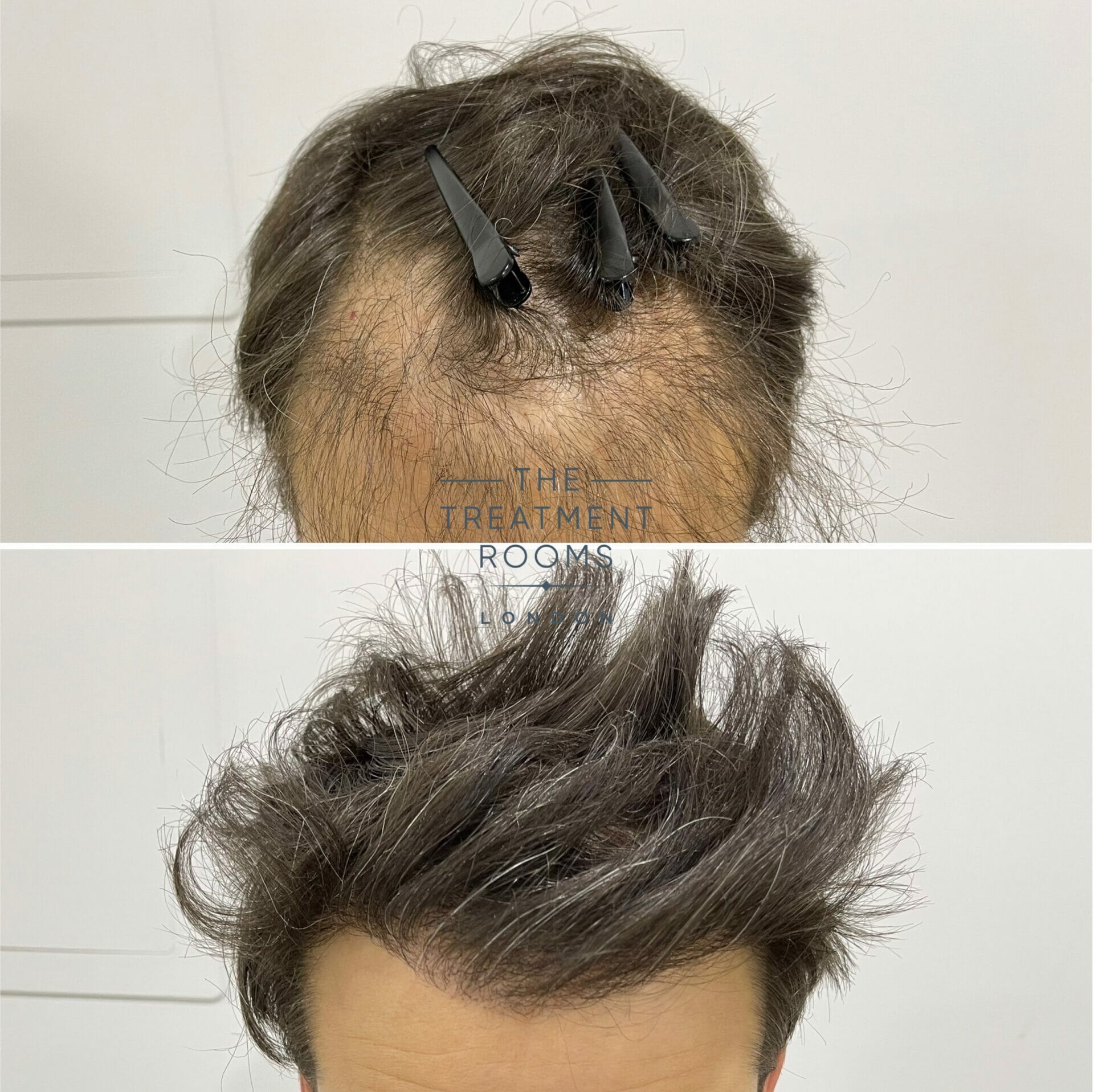 fue Hair transplant repair london before and after