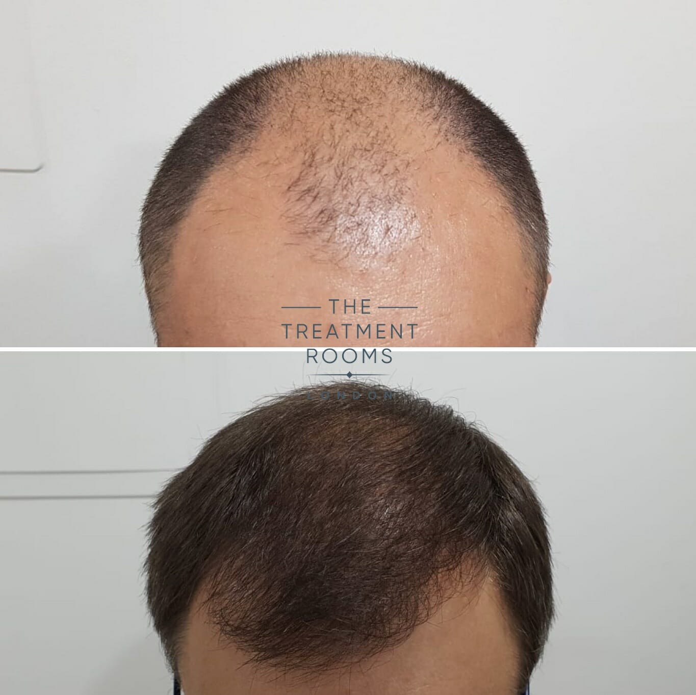 Hair transplant result