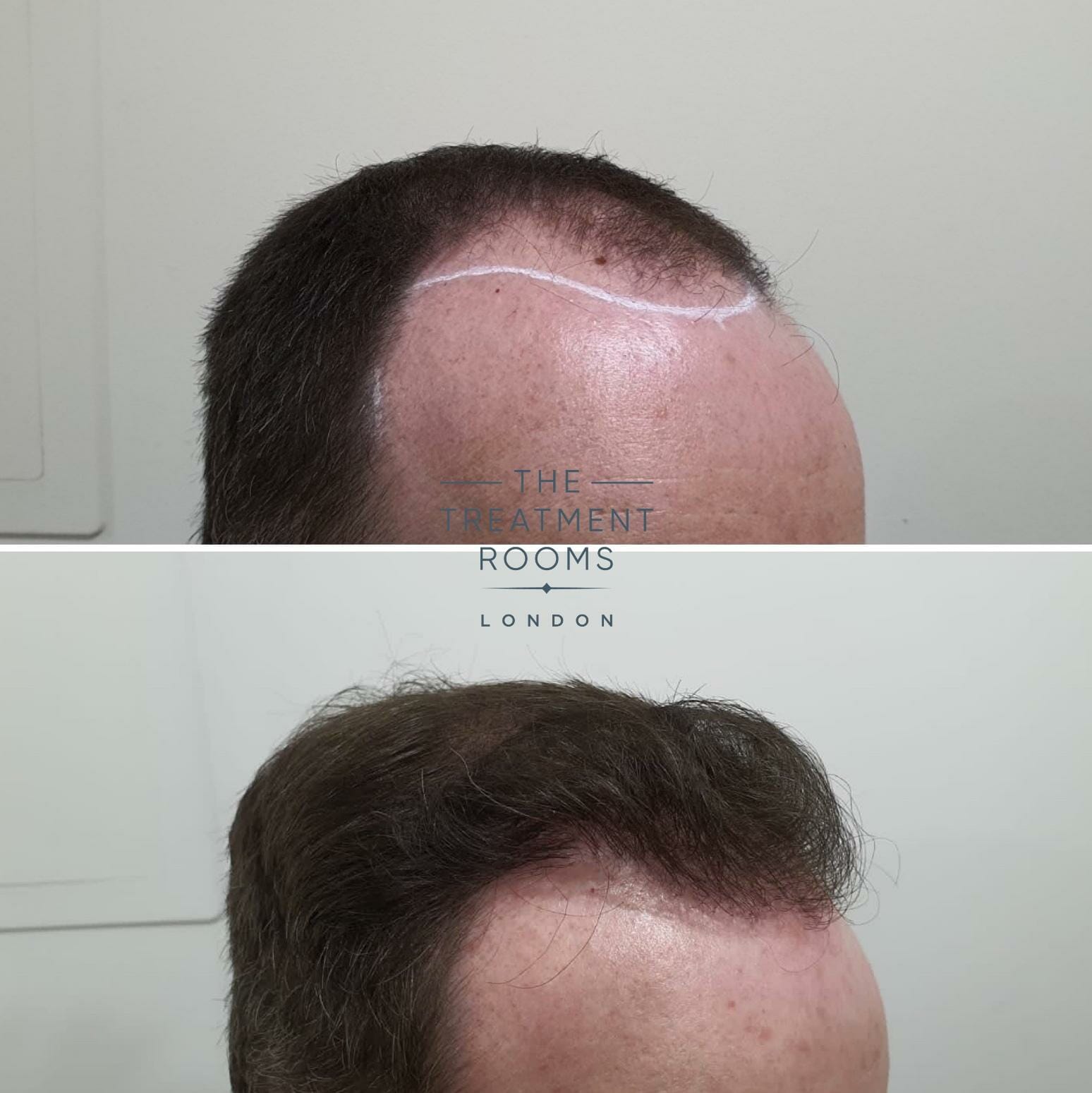 Hair transplant right hairline norwood 4 hair transplant london
