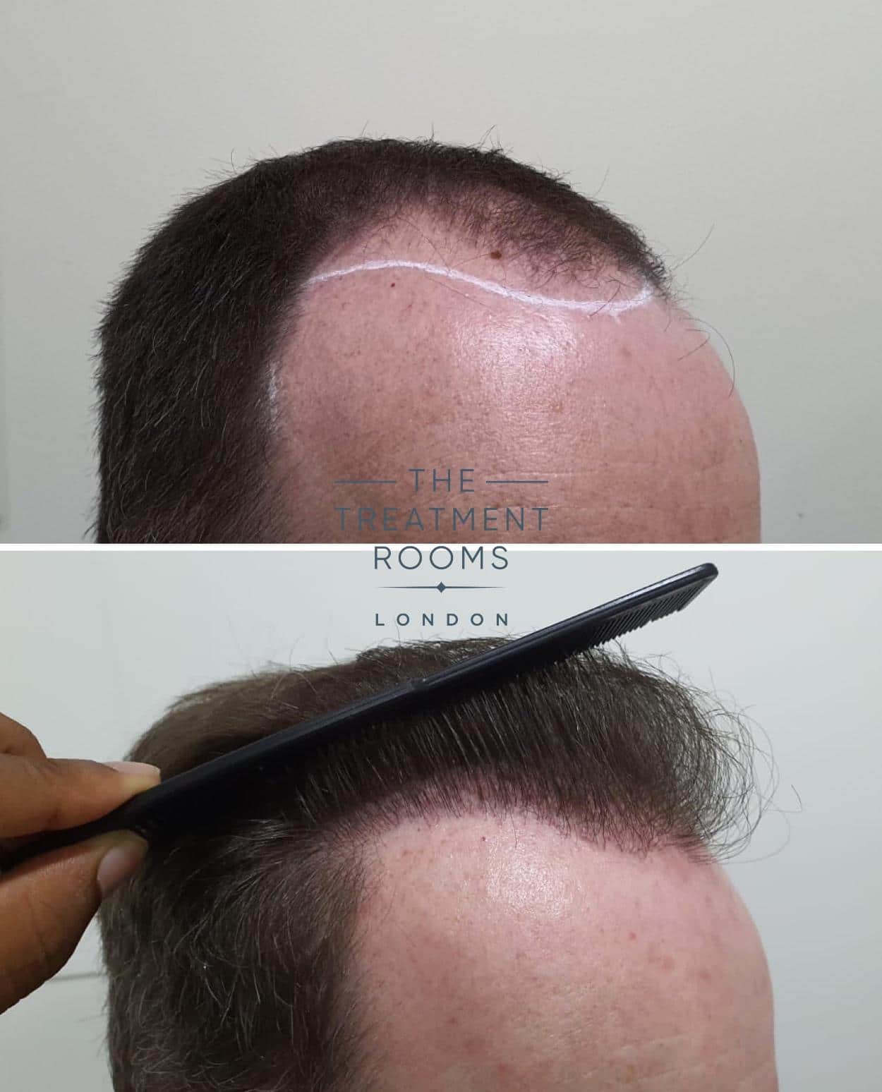 norwood 4 hair transplant result