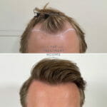 Hairline FUE hair transplant