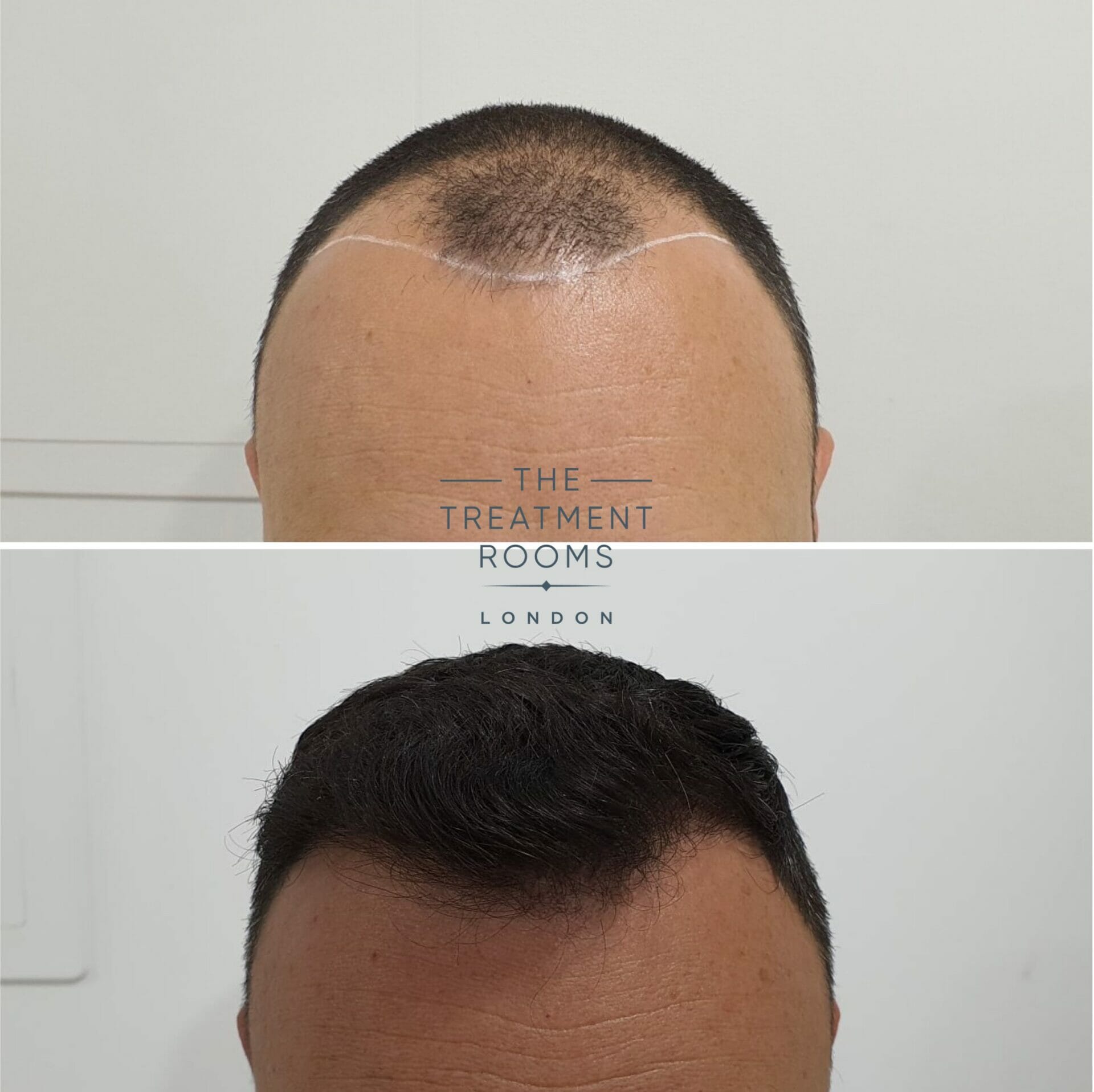 Hairline FUE hair transplant before and after 1498 grafts