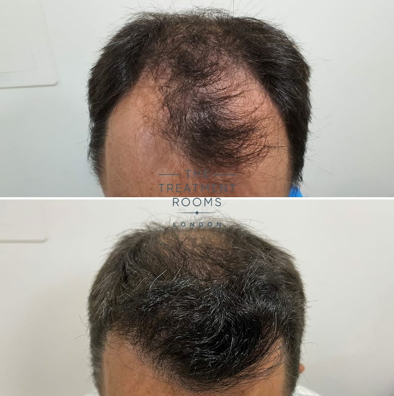 Hairline FUE hair transplant before and after