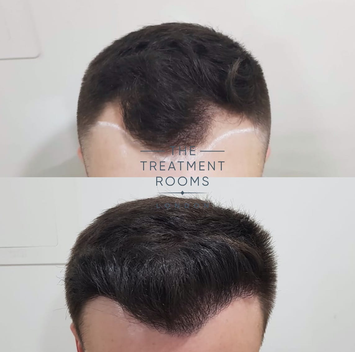 Hairline Hair Transplant