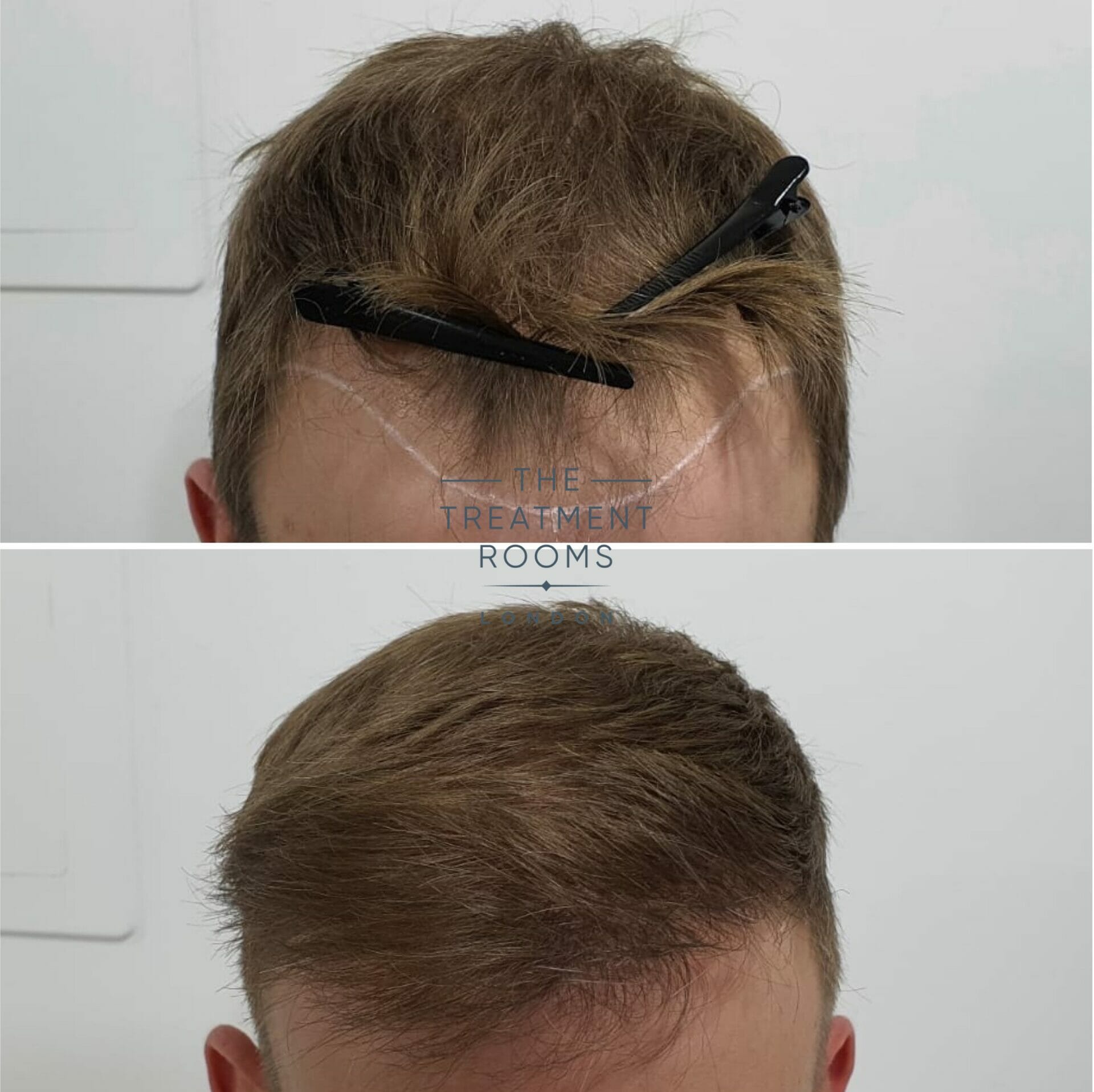 Hairline closeup before and after FUE hair transplant