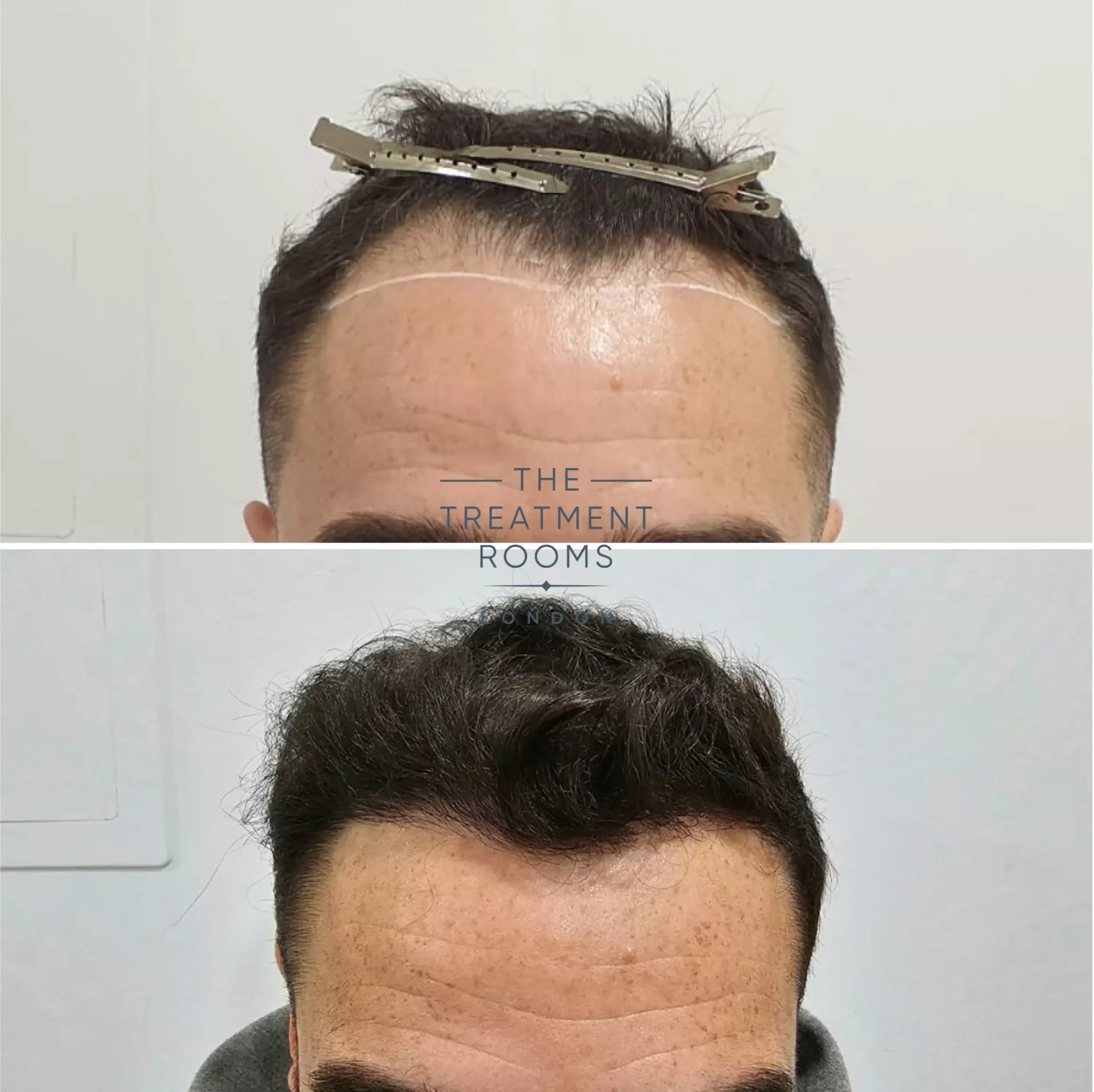 Hairline fue hair transplant 1303 grafts before and after